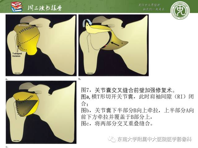 【PPT】术后肩关节MR及MR关节成像-正常与异常影像表现