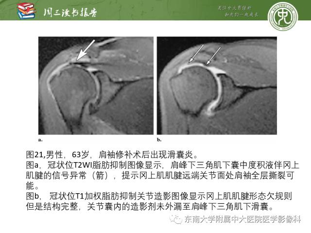 【PPT】术后肩关节MR及MR关节成像-正常与异常影像表现