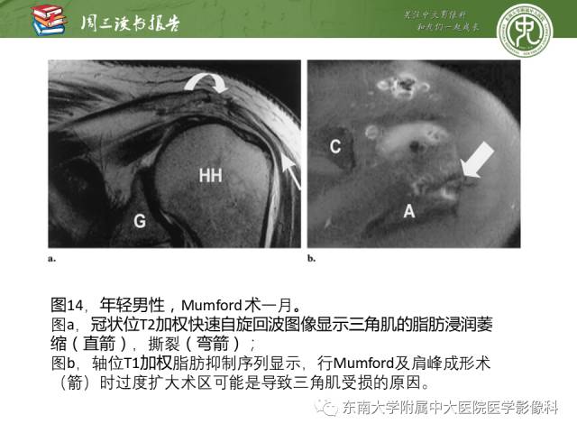 【PPT】术后肩关节MR及MR关节成像-正常与异常影像表现