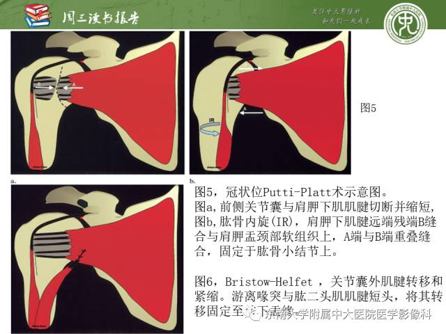 【PPT】术后肩关节MR及MR关节成像-正常与异常影像表现