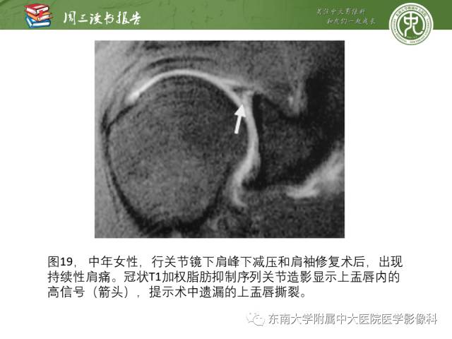 【PPT】术后肩关节MR及MR关节成像-正常与异常影像表现