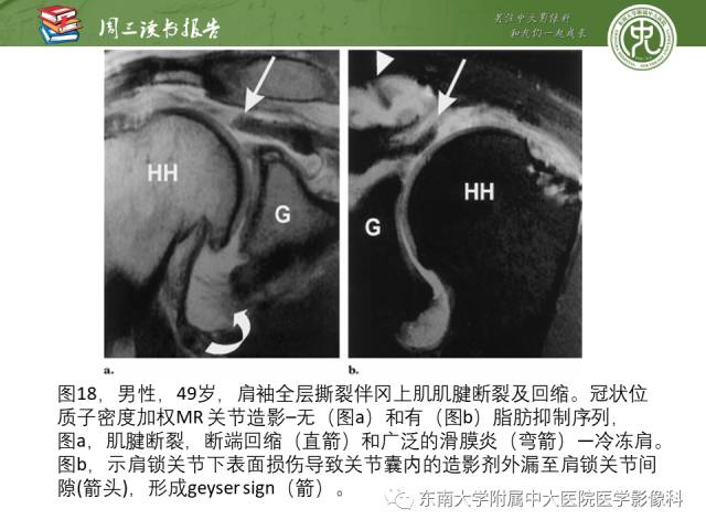 【PPT】术后肩关节MR及MR关节成像-正常与异常影像表现