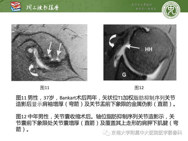 【PPT】术后肩关节MR及MR关节成像-正常与异常影像表现