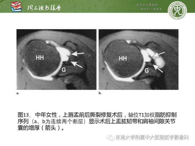 【PPT】术后肩关节MR及MR关节成像-正常与异常影像表现