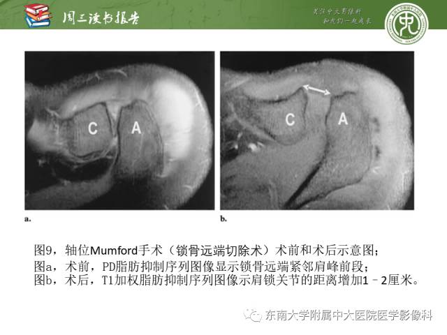 【PPT】术后肩关节MR及MR关节成像-正常与异常影像表现