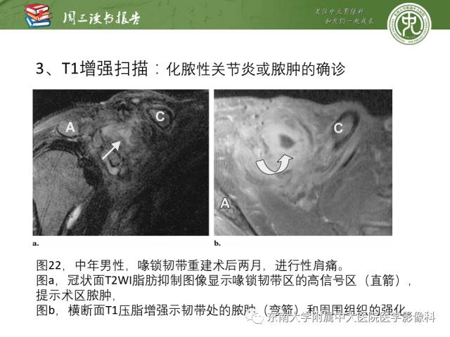 【PPT】术后肩关节MR及MR关节成像-正常与异常影像表现