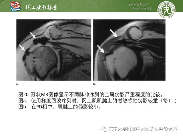 【PPT】术后肩关节MR及MR关节成像-正常与异常影像表现