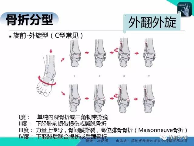 【PPT】基于损伤机制的踝关节急性损伤的影像学评估
