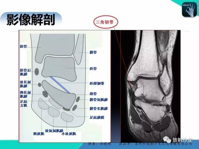 【PPT】基于损伤机制的踝关节急性损伤的影像学评估