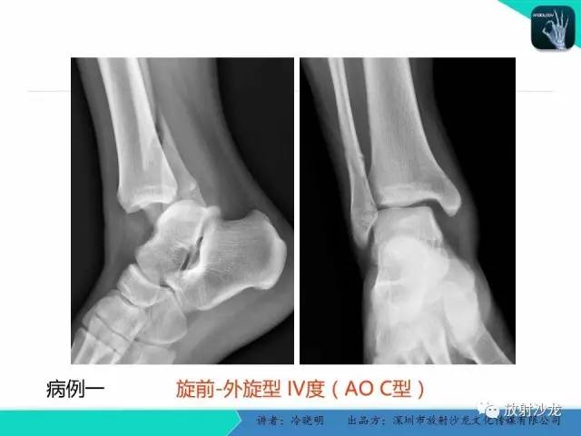 【PPT】基于损伤机制的踝关节急性损伤的影像学评估