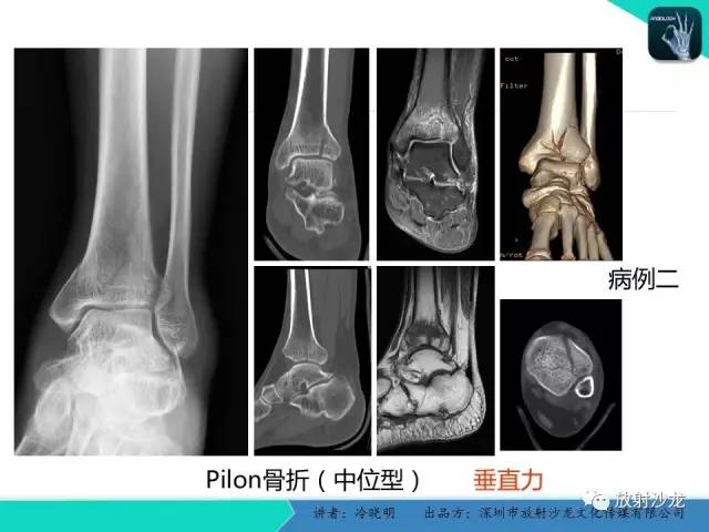 【PPT】基于损伤机制的踝关节急性损伤的影像学评估