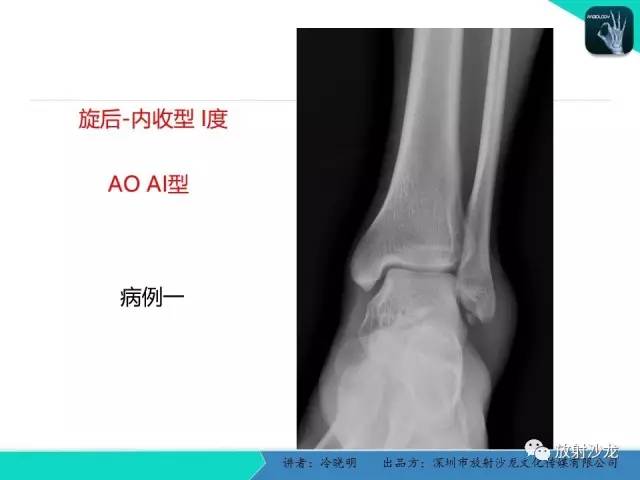 【PPT】基于损伤机制的踝关节急性损伤的影像学评估