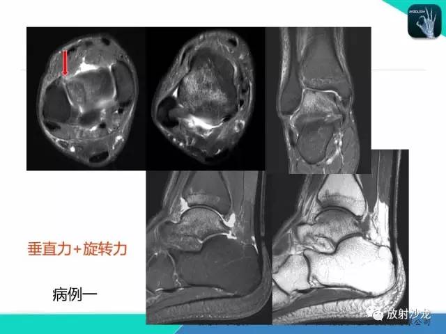 【PPT】基于损伤机制的踝关节急性损伤的影像学评估