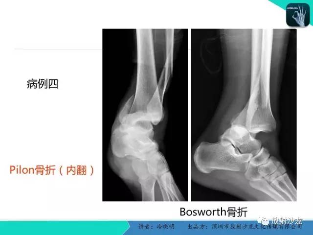 【PPT】基于损伤机制的踝关节急性损伤的影像学评估