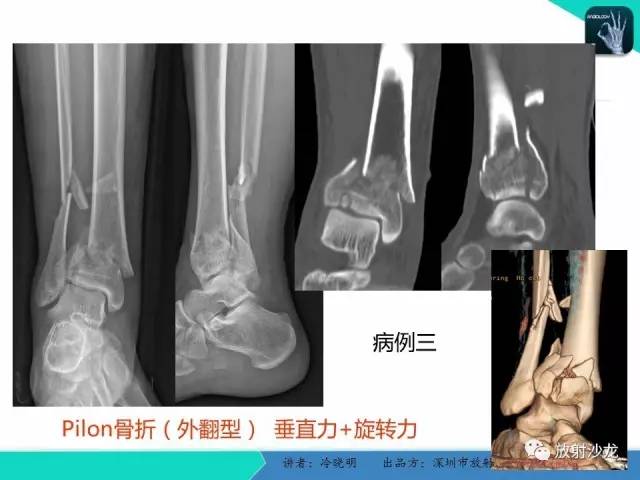 【PPT】基于损伤机制的踝关节急性损伤的影像学评估