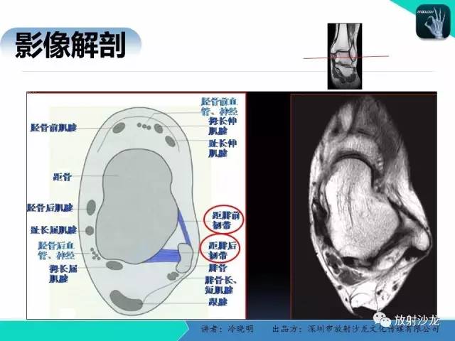 【PPT】基于损伤机制的踝关节急性损伤的影像学评估