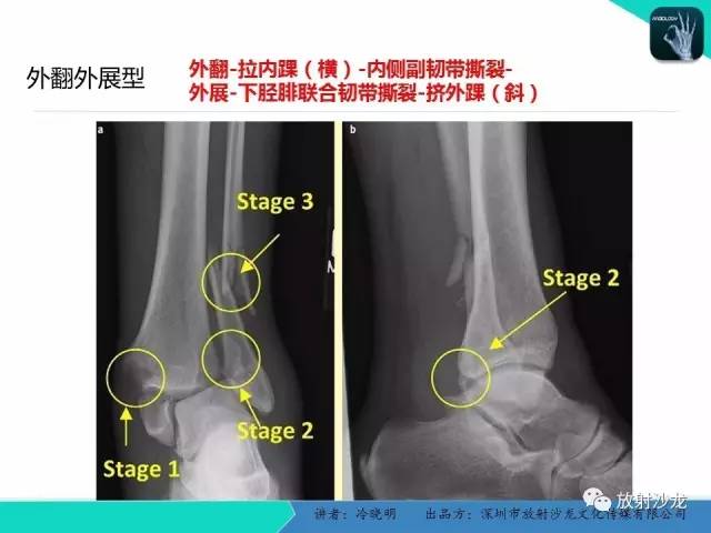 【PPT】基于损伤机制的踝关节急性损伤的影像学评估