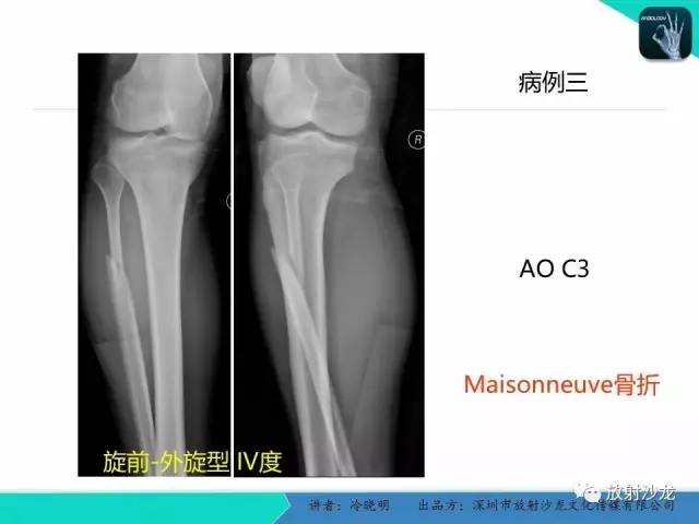 【PPT】基于损伤机制的踝关节急性损伤的影像学评估