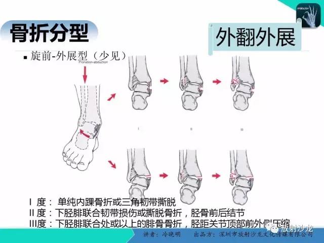 【PPT】基于损伤机制的踝关节急性损伤的影像学评估
