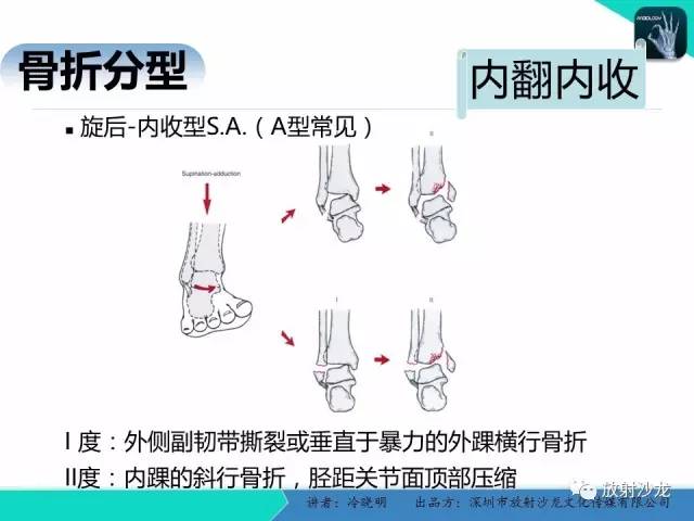 【PPT】基于损伤机制的踝关节急性损伤的影像学评估