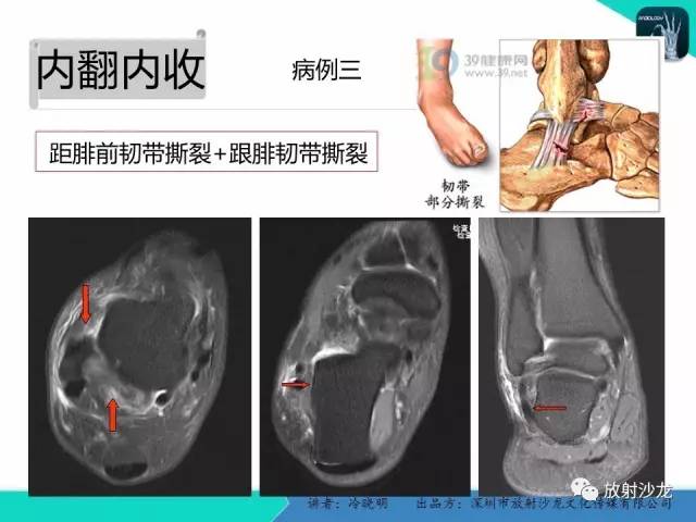 【PPT】基于损伤机制的踝关节急性损伤的影像学评估