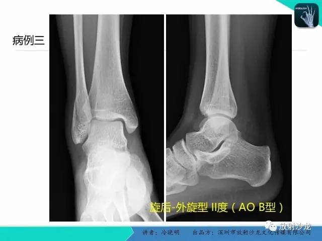 【PPT】基于损伤机制的踝关节急性损伤的影像学评估