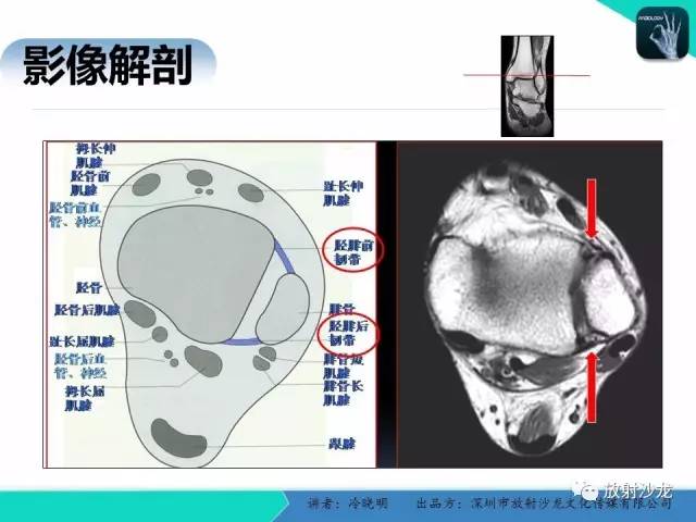 【PPT】基于损伤机制的踝关节急性损伤的影像学评估