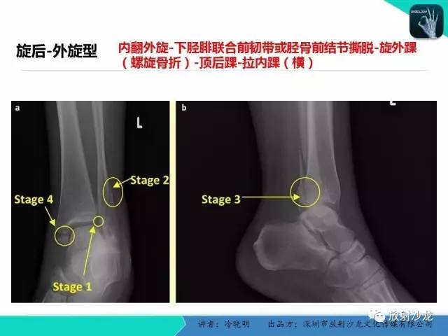 【PPT】基于损伤机制的踝关节急性损伤的影像学评估