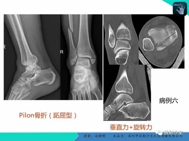 【PPT】基于损伤机制的踝关节急性损伤的影像学评估