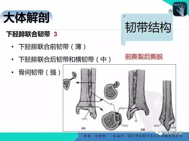 【PPT】基于损伤机制的踝关节急性损伤的影像学评估