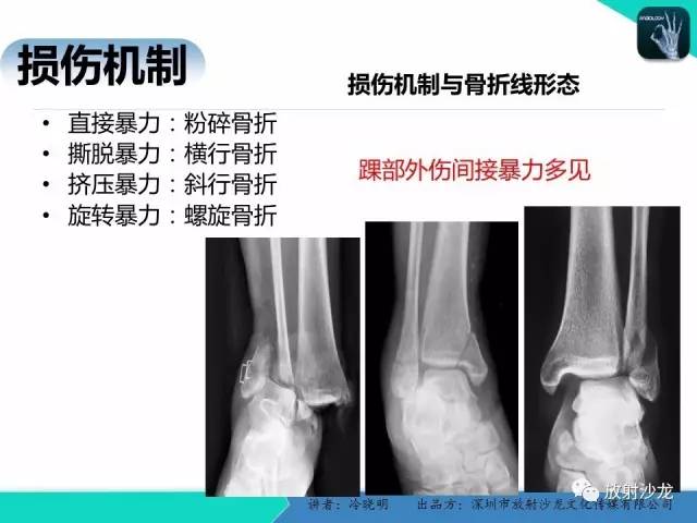 【PPT】基于损伤机制的踝关节急性损伤的影像学评估