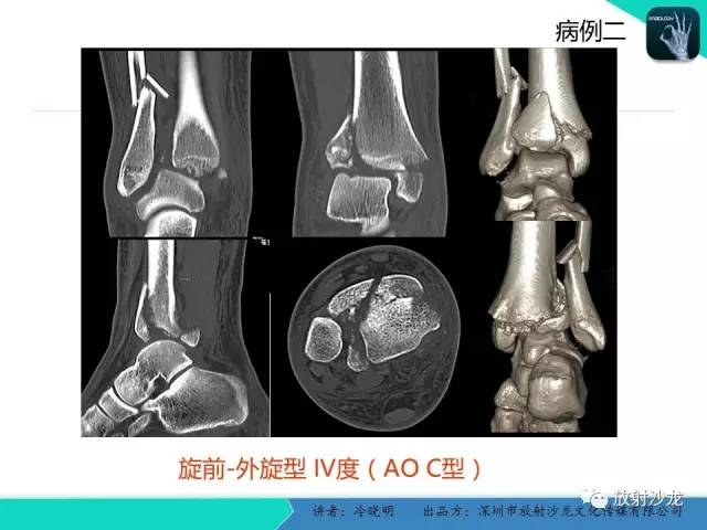 【PPT】基于损伤机制的踝关节急性损伤的影像学评估