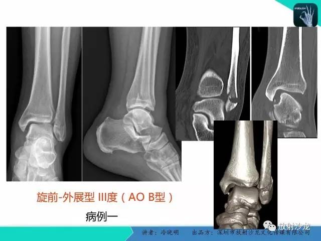【PPT】基于损伤机制的踝关节急性损伤的影像学评估