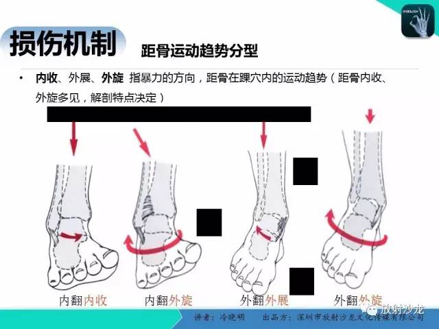 【PPT】基于损伤机制的踝关节急性损伤的影像学评估