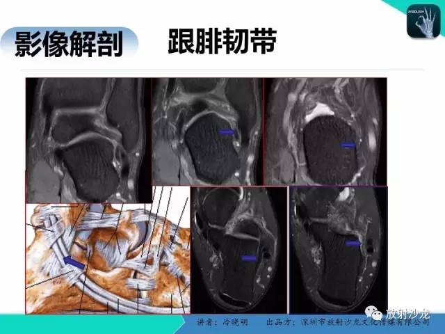【PPT】基于损伤机制的踝关节急性损伤的影像学评估