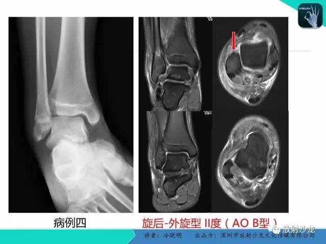 【PPT】基于损伤机制的踝关节急性损伤的影像学评估