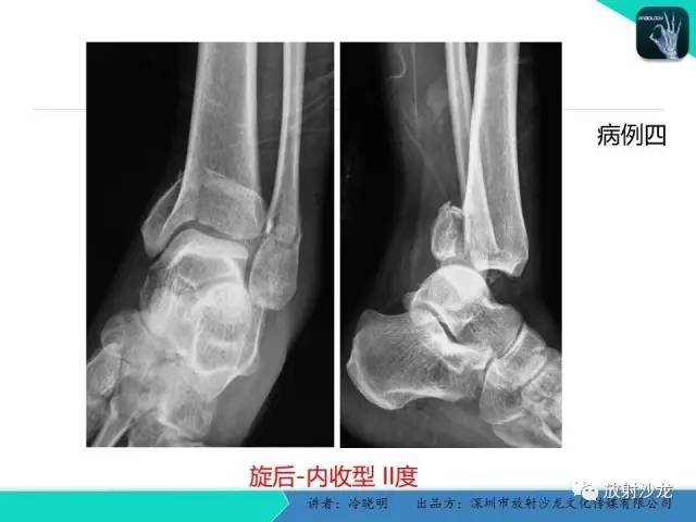 【PPT】基于损伤机制的踝关节急性损伤的影像学评估