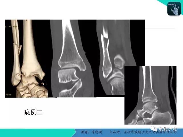 【PPT】基于损伤机制的踝关节急性损伤的影像学评估