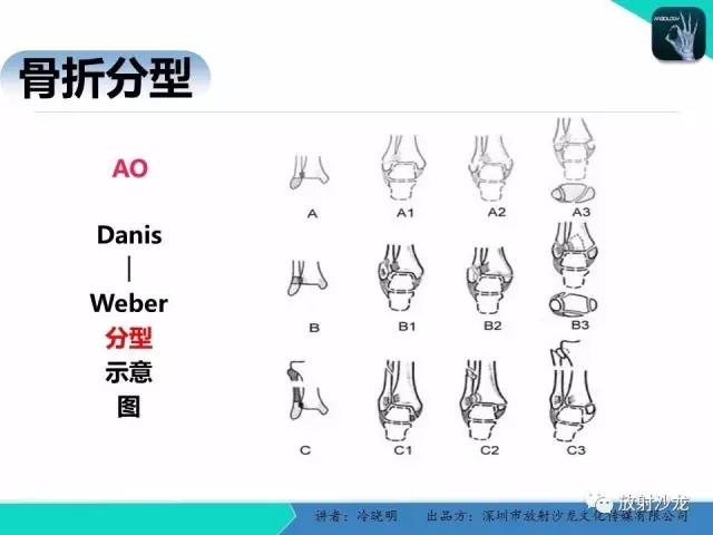 【PPT】基于损伤机制的踝关节急性损伤的影像学评估