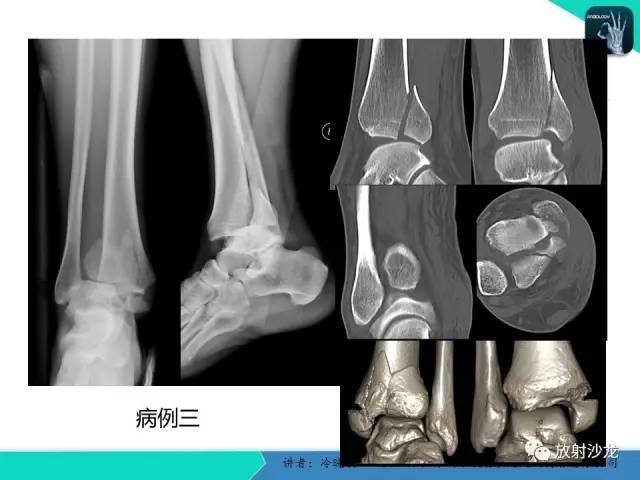 【PPT】基于损伤机制的踝关节急性损伤的影像学评估