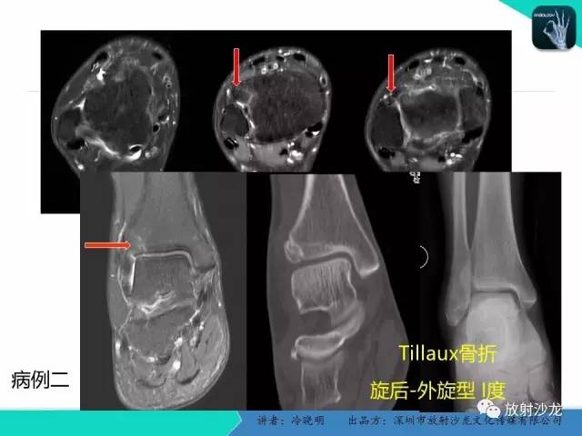 【PPT】基于损伤机制的踝关节急性损伤的影像学评估