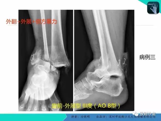 【PPT】基于损伤机制的踝关节急性损伤的影像学评估