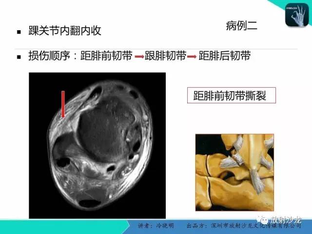 【PPT】基于损伤机制的踝关节急性损伤的影像学评估
