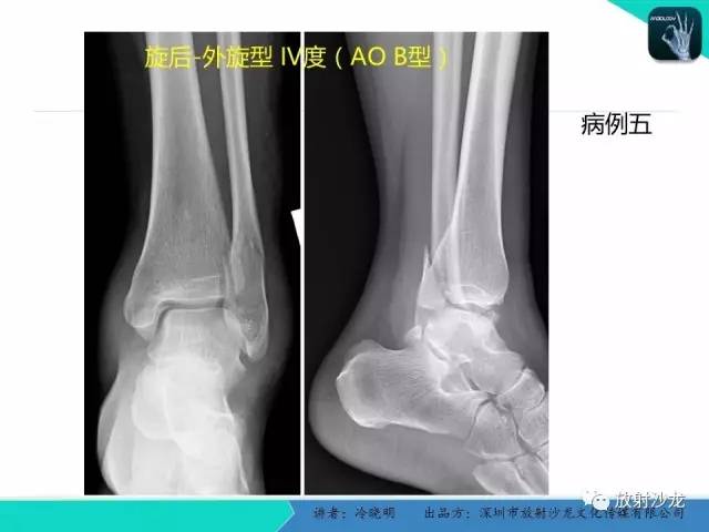 【PPT】基于损伤机制的踝关节急性损伤的影像学评估