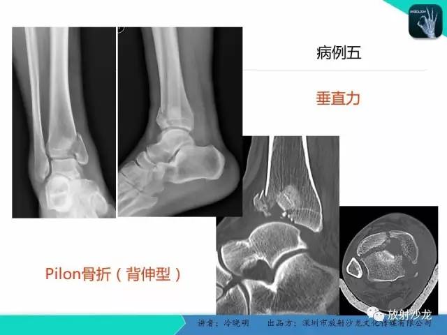 【PPT】基于损伤机制的踝关节急性损伤的影像学评估