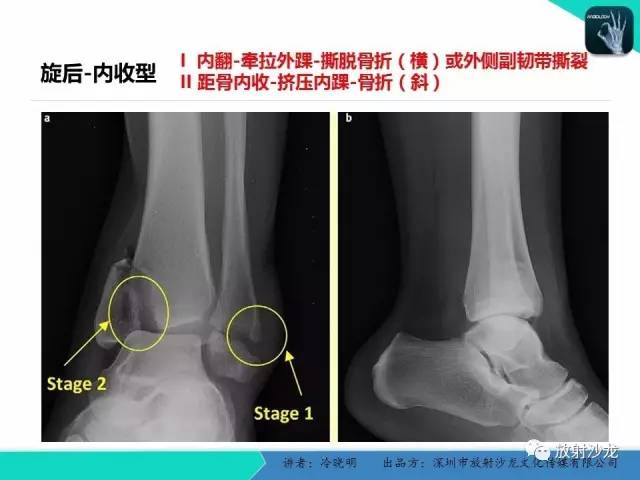 【PPT】基于损伤机制的踝关节急性损伤的影像学评估