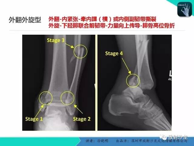 【PPT】基于损伤机制的踝关节急性损伤的影像学评估