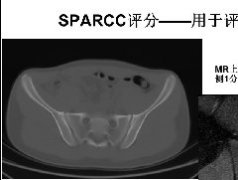 强直性脊柱炎SPARCC评分