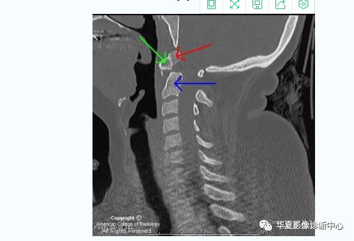 【病例】游离齿状突/齿状突小骨1例CT影像表现