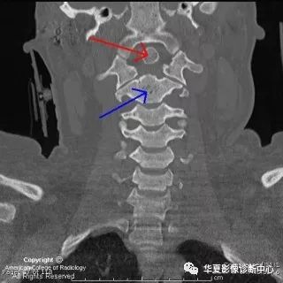 【病例】游离齿状突/齿状突小骨1例CT影像表现